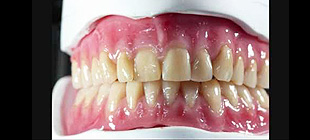 カラーリング義歯イメージ2