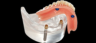 インプラント義歯イメージ1