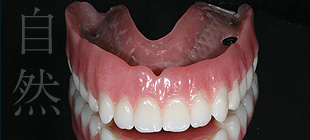 インプラント義歯イメージ2