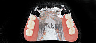 金属床義歯イメージ1