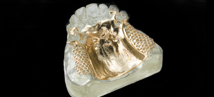 金属床義歯イメージ2