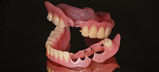 ノンクラスプ義歯イメージ1