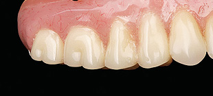 シリコン義歯イメージ1