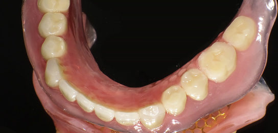 高吸着性の下顎の入れ歯