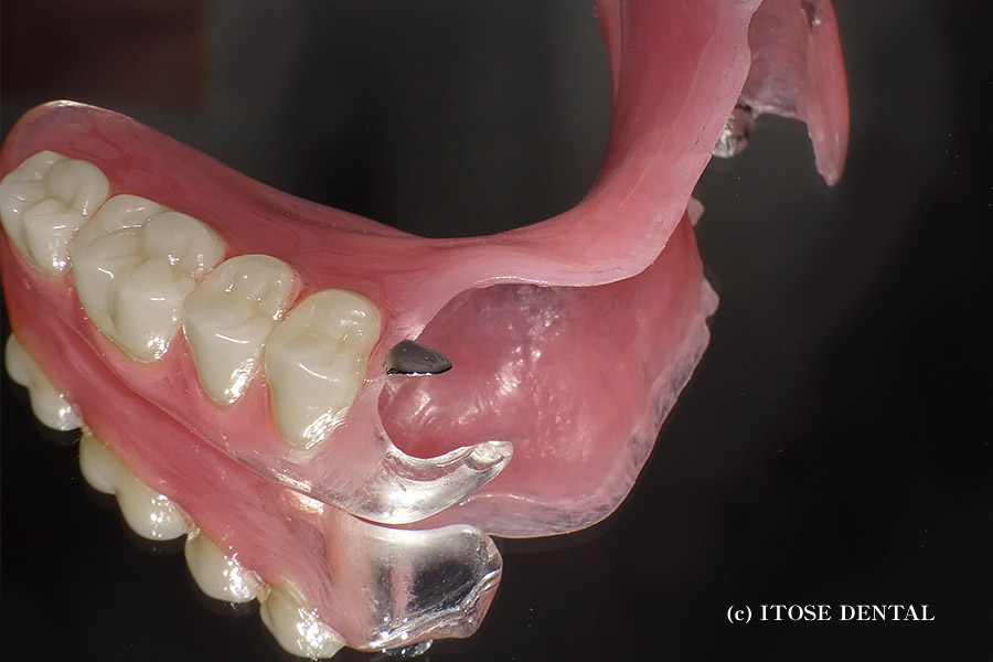 見えない部分入れ歯