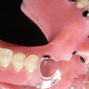 大分県の入れ歯治療