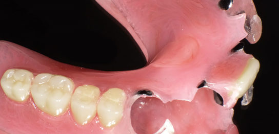 大分県の入れ歯治療