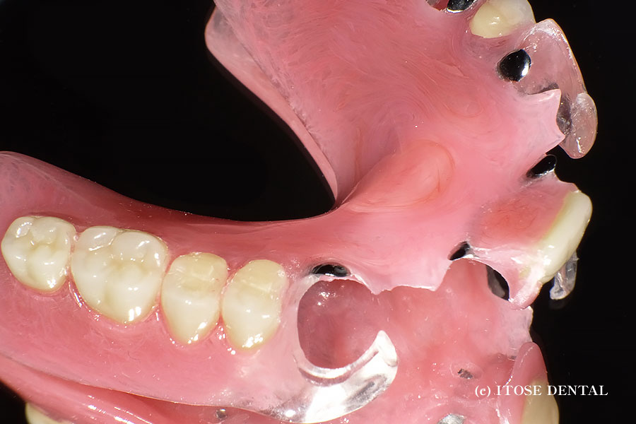 nonclasp-denture-case01-2.jpg