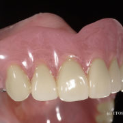 大分県の入れ歯の症例