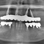 インプラント治療2